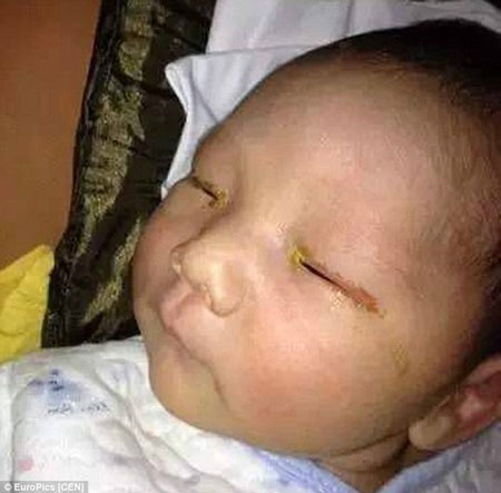 Em bé bị mù một mắt vì chụp hình quên tắt đèn flash